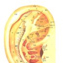 귀건강(이혈테라피) 이미지