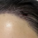 한빛헤어센스 | [헤어라인이식]모발이식 모디헤어플란트 당일-3일차 경과 후기 (지인 할인 받기 정보)