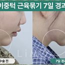 주)중앙응급환자이송단 | 이중턱 근육묶기 내돈내산 시술 후 변화 분석