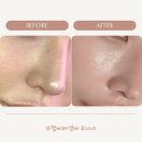 더베이지의원 | 선릉역 로사의원 소프웨이브 리프팅 가격,효과,통증,부작용,유지기간,샷수,경과 내돈내산 후기