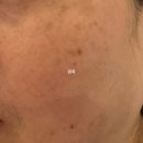 순수안피부과의원 | 200만원으로 피부과에서 레이저로 엄마 기미제거 해주기 (12회차 중 1회차)