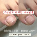 내성집 | 부산 내성발톱 패디당 후기, 10년 넘게 방치했던 문제성 발톱 관리
