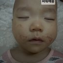 자연치유음식연구소 | 신생아 아토피 관리 후기(스테로이드x, 완정, 자연치유)