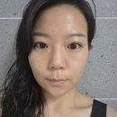 룰루멍 | 서면피부과 스킨보톡스 잘하는 곳 방문 후기 :: 일주일 전후비교 총정리 (ft. 멍 붓기 정보)