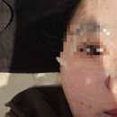 신논현역 데이뷰의원 포텐자 리즈네 통증 엠보 솔직후기