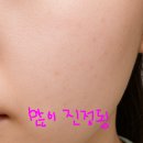 콜드플라즈마 | 콜드 플라즈마 부작용 중단 후 관리 후기