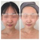 비채움뷰티 | 안면비대칭 교정 + 색소침착 1회만에 효과보기 '셀럽뷰티어겐' 체질관리 화사독술MTS