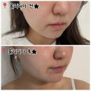 365 | 천호피부과 올리디아365 후기 | 팔자주름 콜라겐 볼륨주사 효과