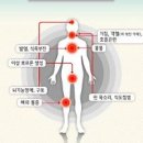 폐암 초기증상 가래 손톱 곤봉지 이미지