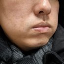 삼성동-5 | 강남 삼성동피부과 남자 수염레이저 실킨제모 5회차 후기