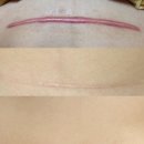 시트모아 | 시카케어 겔시트 제왕절개 흉터밴드 사용법 2개월 후기