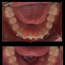e-Art 치과기공소 | 치간삭제란 무엇일까? 치아교정에서 활용되는 이유부터 통증과 부작용까지 총정리