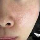 파주피부관리 스킨부스터 mts후기 데콜테맛집 제이안뷰티