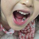 글로리치과의원 | 대전 어린이 치과 동구 가오동 AK플란트치과 유아 충치 치료 후기