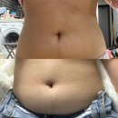 멍스토리 | 복부 무한람스 가격/후기/멍 뭉침 당일~4달차 관리
