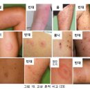 미화세탁 | 🇫🇷프랑스 교환학생(+) 🪳베드버그(빈대) 특징/대처법/퇴치 후기...