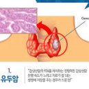 갑상선 유두암 갑상선암 원인 초기 증상 결절 전이 치료 이미지