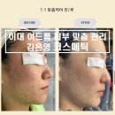 [서울/이대] 문제성 피부/ 여드름피부 맞춤관리 &#39;김은영 코스메틱&#39; 만족후기