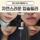 비포애프성형외과 | 신논현 성형외과 더채움 자연스러운 입술 필러 1cc 후기