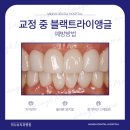 미니쉬치과기공소 네이버블로그