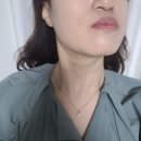 압구정 성형외과 목주름 자가진피재생술 당일 1주일 시술 후기