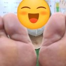 손태석 발가락운동용구 | 두번째 세번째 발가락통증, 지간신경종, 발가락이 찌릿찌릿 신체발란스운동 3개월 체험후기