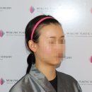 “너무 둥글게는 싫었어요” 자연스러운 M자 헤어라인교정 후기