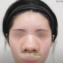 예쁜 코의 공통점은? 성형외과 원장이 알려주는 코 성형 성공하는 방법(리얼 후기 케이스)