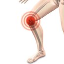 무릎 연골 손상이란 무엇인가? 이미지