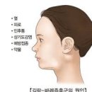 길랑바레 증후군 증상과 원인 치료 이미지