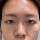 대구 얼굴요철관리 편평사마귀제거 페이즈 스킨케어 후기
