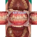 11590-다12 | 뿌리 끝 깊은 염증으로 흔들리던 어금니 임플란트 대구 본동 치과