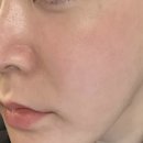 산성하나약국 | 셀프 mts 후기 눈가 잔주름 개선 0.25mm 편