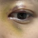 [후기] 25살에 별안간 쌍수를 하게 된 것에 대하여 / 눈매교정 후기