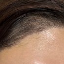 까만손모터라인 | 여자 3600모 헤어라인 절개 모발이식 5개월 후기 암흑기 m자탈모 모발이식 생착률 내돈내산 비용