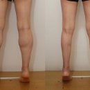 관리] 종아리근감소증 예방과 종아리지방흡입을 통한 하체 라인 교정 가이드 - 가격.비용.효과.후기.관리