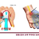 손발이 저리다, 감각이 없다[paresthesia, numbness] 이미지