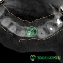 2080자연이치과의원 | 6 앞니 임플란트,자연스러움은 어디서 결정될까요?｜디지털 네비게이션·보철 디자인의 차이