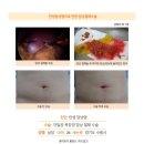 만성담낭염수술후기. 수술을 미루고 미루다가 응급실에서 급성 담낭염 소견을 받고 급히 수술을 받기 위해 병원을 찾았습니다. 이미지