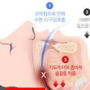 코 막히는 이유 및 막힌 코 코막힘 뚫는 법 자세 이미지