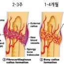 운정세움한의원 | 골유합지연과 골절불유합의 치료 - 궁귀탕, 접골탕