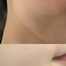 메이멍 | 괄사 마사지 부작용 얇은 피부 멍자국 관리 후기ㅜㅜ