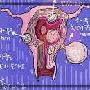하이푸시술 후기 입원 필요한 경우