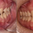 세민치과의원 | 6월달의 교정 후기 감사합니다