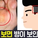 발바닥 굳은살'과 '흰머리'가 보내는 부위별 건강 적신호 - 건강 관상 '한의학' 편 | 나는 몸신이다 이미지