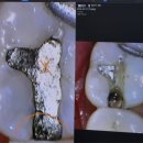 당산역 치과 스케일링 잘하는 치과에서 과잉진료 없이 충치 치료도 받은 후기