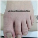 좋은세상제암의원 | 발톱 통증 참지 말고 빨리 치료해요 ! 구파발 365이화웃는세상의원 내성발톱 치료 후기.