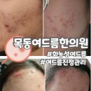 진정한의원 | 목동 여드름 한의원 화농성 여드름 진정케어 후기
