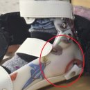 [소아 뇌성마비 발 보조기] 관절형 AFO 맞춤 제작 후기