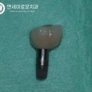 받은 곳이 아프다면? 원인은 바로, 치아 뿌리 염증 - 선유도 치과 발치 후 임플란트 식립으로 통증 극복